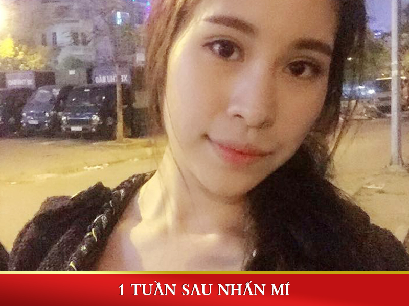 Hình ảnh nhấn mí mắt sau một tuần